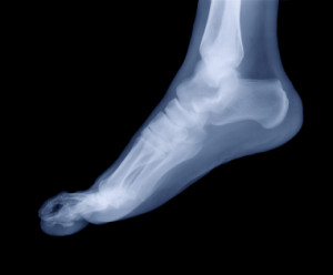 foot_xray